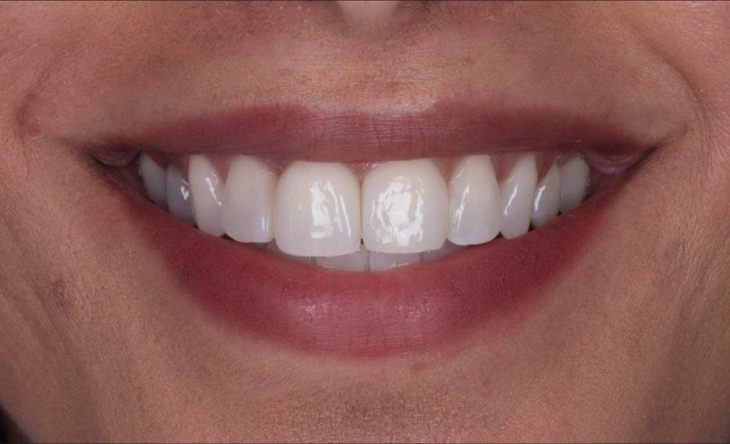 receding gums