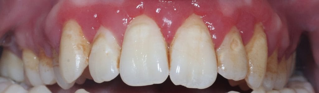 gum disease treatment