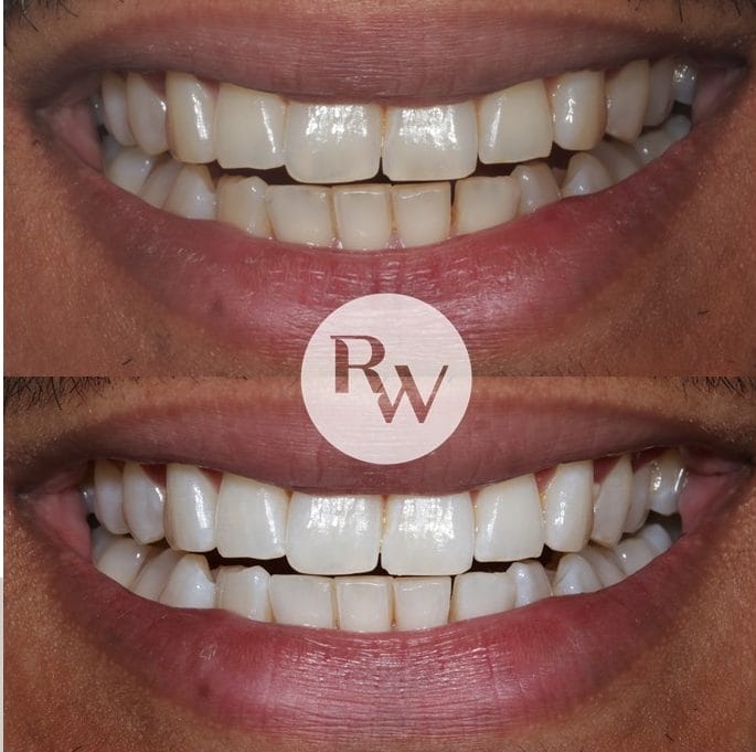 polish and perfect teeth cleaning, periodontist london