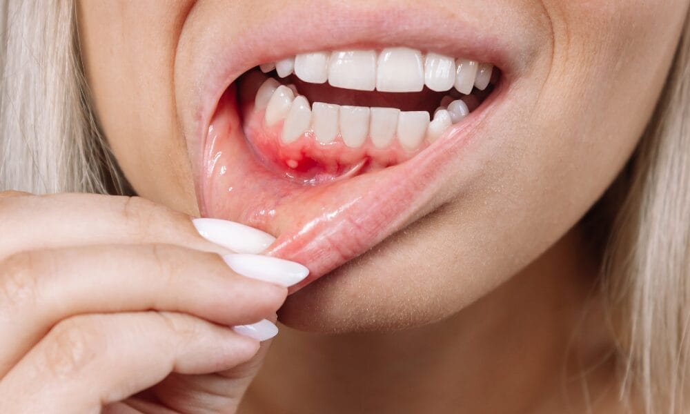 Periodontitis issue